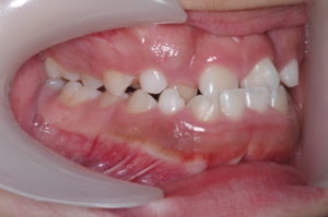 つくば・土浦の矯正歯科　つるみ矯正歯科　歯並び矯正症例A　叢生（乱杭歯）2a